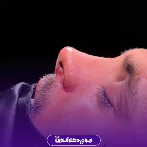 نمونه کار قبل و بعد عمل بینی دکتر امیرحسین اسدالله‌پور 1