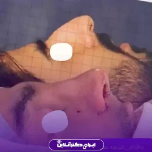 نمونه کار عمل بینی دکتر آرش کرمی 1
