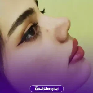 نمونه کار عمل بینی دکتر آرش کرمی 10