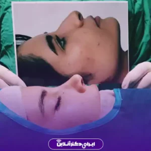 نمونه کار عمل بینی دکتر آرش کرمی 4