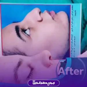 نمونه کار عمل بینی دکتر آرش کرمی 8