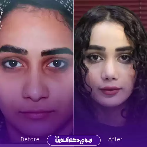 نمونه کار قبل و بعد عمل بینی دکتر حسینی واجاری 1