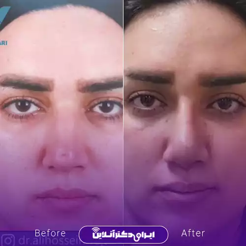 نمونه کار قبل و بعد عمل بینی دکتر حسینی واجاری 2