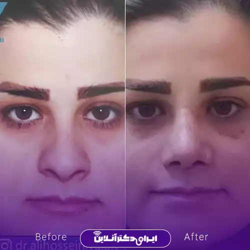 نمونه کار قبل و بعد عمل بینی دکتر حسینی واجاری 3