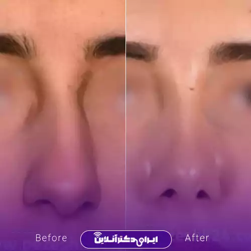 نمونه کار عمل بینی دکتر مریم تهرانی 2