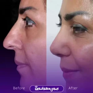 نمونه کار عمل بینی دکتر مهدی قائدی 5