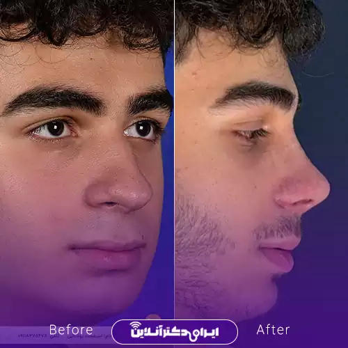 نمونه کار عمل بینی دکتر مصطفی مهری 2