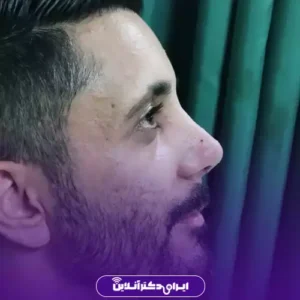 نمونه کار عمل بینی دکتر نفیسه صادق زاده 2