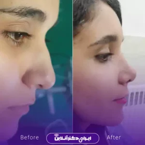 نمونه کار عمل بینی دکتر نفیسه صادق زاده 6