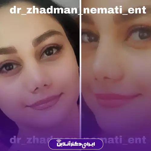 نمونه کار قبل و بعد عمل بینی دکتر نعمتی 1