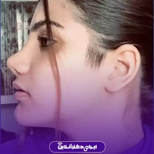 نمونه کار قبل و بعد عمل بینی دکتر نعمتی 2