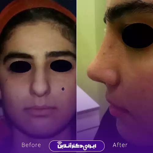 نمونه کار قبل و بعد عمل بینی دکتر نعمتی 3