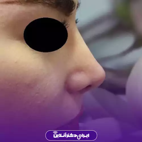 نمونه کار قبل و بعد عمل بینی دکتر نعمتی 4
