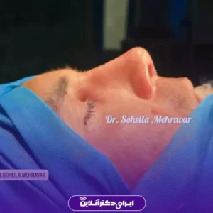 نمونه کار عمل بینی دکتر سهیلا مهرآور 1
