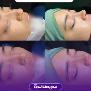 نمونه کار عمل بینی دکتر سهیلا مهرآور 10