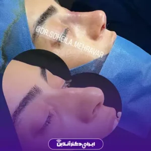 نمونه کار عمل بینی دکتر سهیلا مهرآور 2