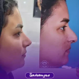 نمونه کار عمل بینی دکتر سهیلا مهرآور 5