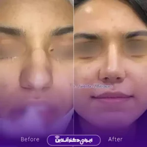 نمونه کار عمل بینی دکتر سهیلا مهرآور 6