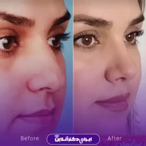 نمونه کار عمل بینی دکتر سهیلا مهرآور 7