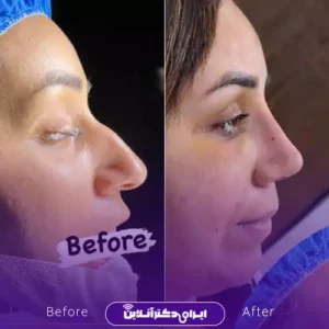 نمونه کار عمل بینی دکتر سهیلا مهرآور 8