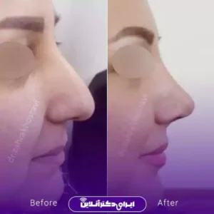 نمونه کار عمل بینی دکتر زهرا خسروی 1