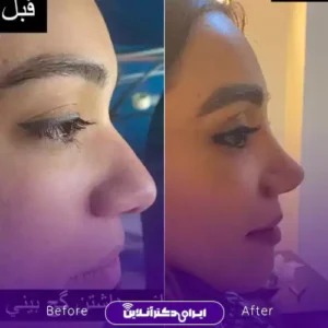نمونه کار عمل بینی دکتر زهرا خسروی 2