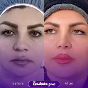 نمونه کار عمل بینی دکتر زهرا خسروی 3