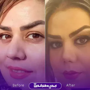 نمونه کار عمل بینی دکتر زهرا خسروی 4