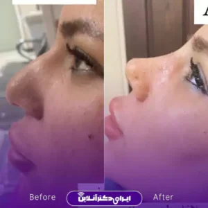 نمونه کار عمل بینی دکتر زهرا خسروی 5