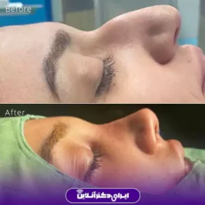 نمونه کار عمل بینی دکتر زهرا خسروی 7