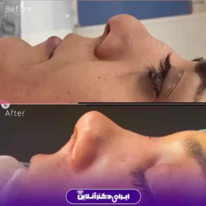 نمونه کار عمل بینی دکتر زهرا خسروی 8