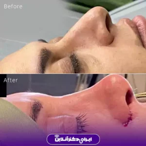 نمونه کار عمل بینی دکتر زهرا خسروی 9