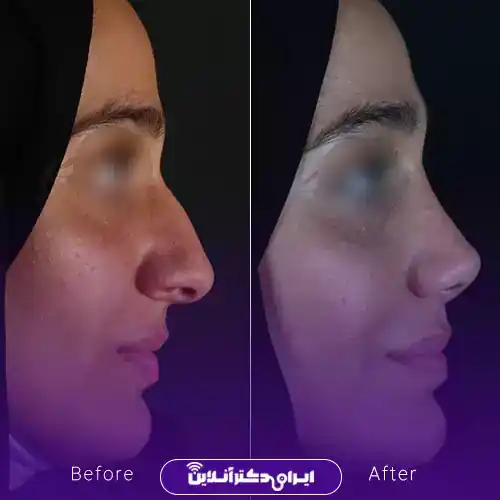 رفع قوز بینی با لیزر؛ لیزر قوز بینی واقعیت دارد؟ 8 نمونه رفع قوز بینی با جراحی