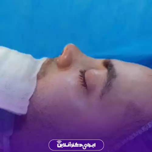 نمونه کار عمل بینی دکتر الهام طیبی 1
