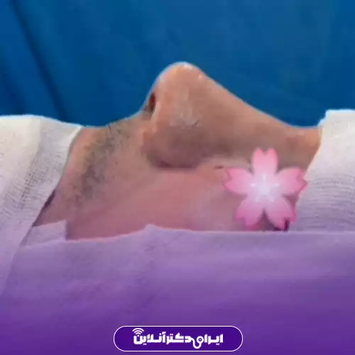 نمونه کار عمل بینی دکتر الهام طیبی 2