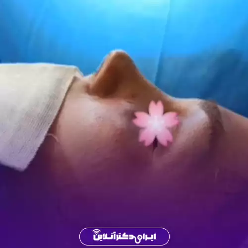 نمونه کار عمل بینی دکتر الهام طیبی 3