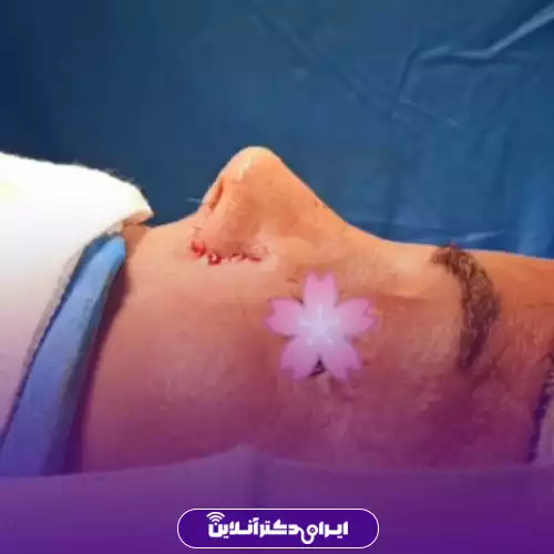 نمونه کار عمل بینی دکتر الهام طیبی 4