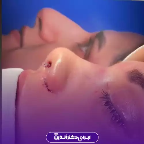 نمونه کار عمل بینی گوشتی دکتر نوشین فتوحی در رشت 2