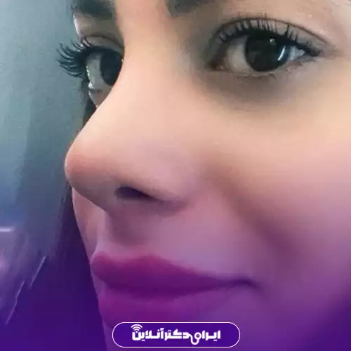 نمونه کار جراحی بینی دکتر عبدالمجید کثیری 1