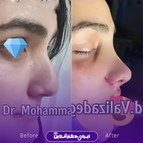 نمونه کار جراحی بینی دکتر محمد ولی زادگان 1