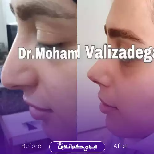 نمونه کار جراحی بینی دکتر محمد ولی زادگان 2