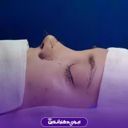 نمونه کار جراحی بینی دکتر سعید نجفی ثانی 1