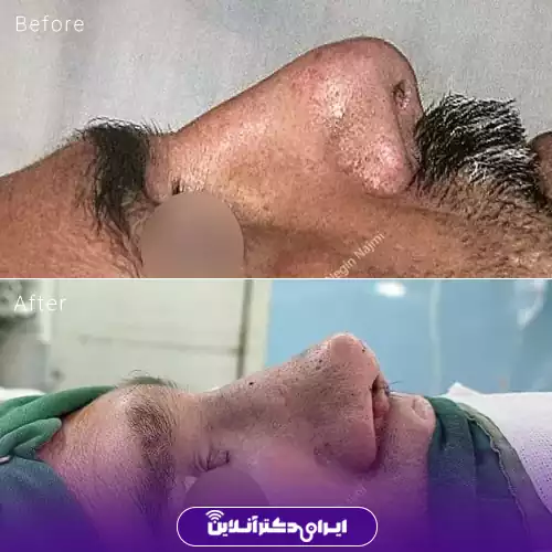نمونه کار جراحی بینی گوشتی دکتر نجمی رشت 1