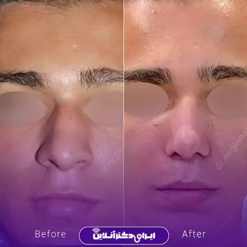 نمونه کار جراحی بینی گوشتی دکتر نجمی رشت 3
