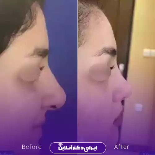نمونه کار جراحی بینی گوشتی دکتر نجمی رشت 4
