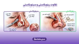 تفاوت سپتوپلاستی و رینوپلاستی