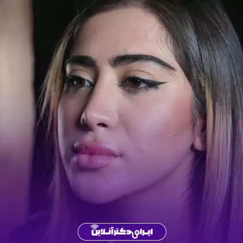 نمونه کار قبل و بعد جراحی بینی طبیعی در تهران توسط دکتر راستکاری 2