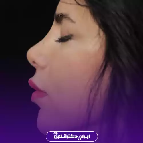نمونه کار قبل و بعد جراحی بینی طبیعی در تهران توسط دکتر راستکاری 3