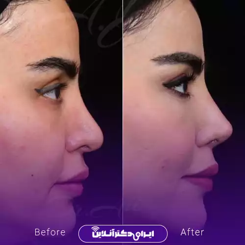 نمونه جراحی قبل و بعد بینی مدل طبیعی دکتر جاودانی در تهران 1