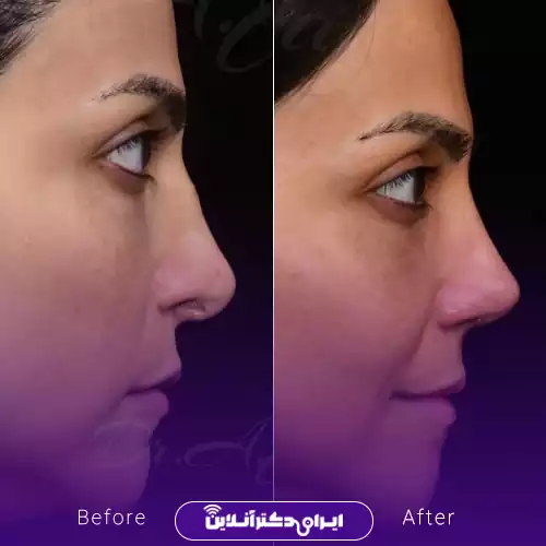 نمونه جراحی قبل و بعد بینی مدل طبیعی دکتر جاودانی در تهران 2
